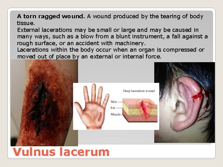 A torn ragged wound. A wound produced by the tearing of body tissue. External
