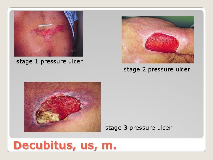 stage 1 pressure ulcer stage 2 pressure ulcer stage 3 pressure ulcer Decubitus, m.