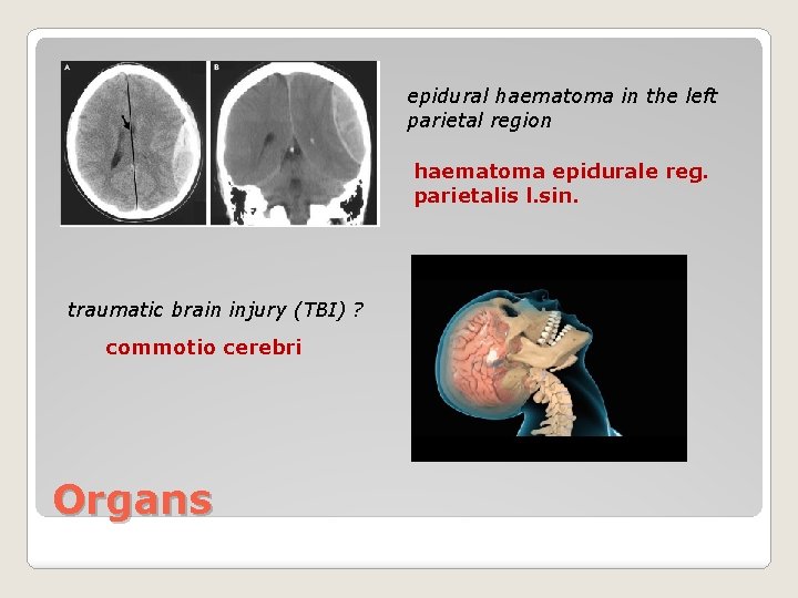 epidural haematoma in the left parietal region haematoma epidurale reg. parietalis l. sin. traumatic