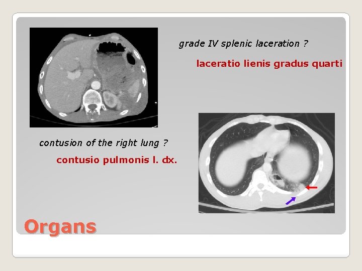 grade IV splenic laceration ? laceratio lienis gradus quarti contusion of the right lung