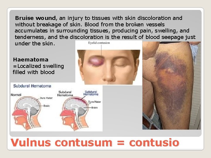 Bruise wound, an injury to tissues with skin discoloration and without breakage of skin.