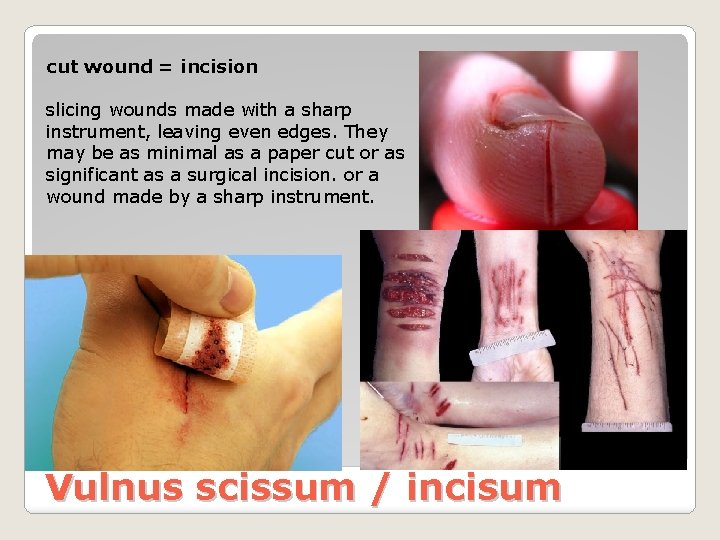 cut wound = incision slicing wounds made with a sharp instrument, leaving even edges.