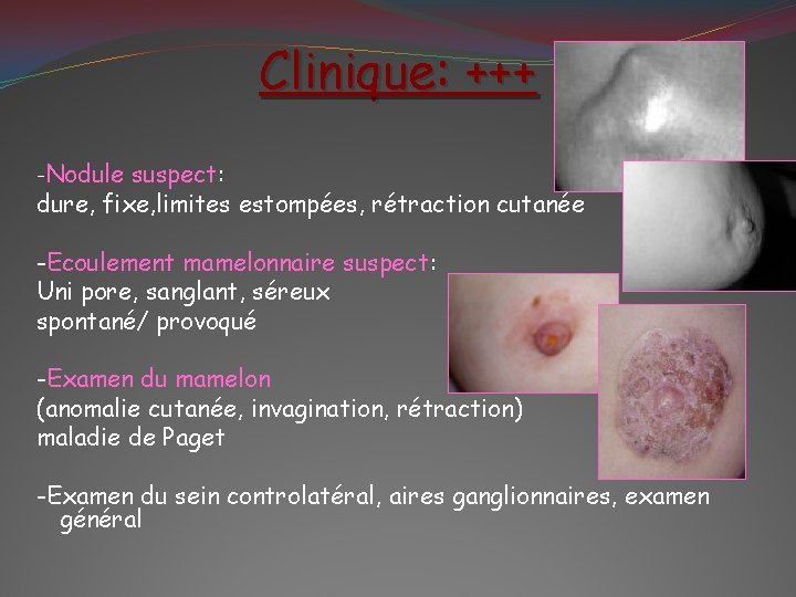 Clinique: +++ -Nodule suspect: dure, fixe, limites estompées, rétraction cutanée -Ecoulement mamelonnaire suspect: Uni