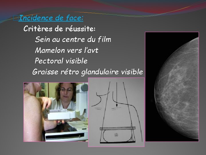 �Incidence de face: Critères de réussite: Sein au centre du film Mamelon vers l’avt