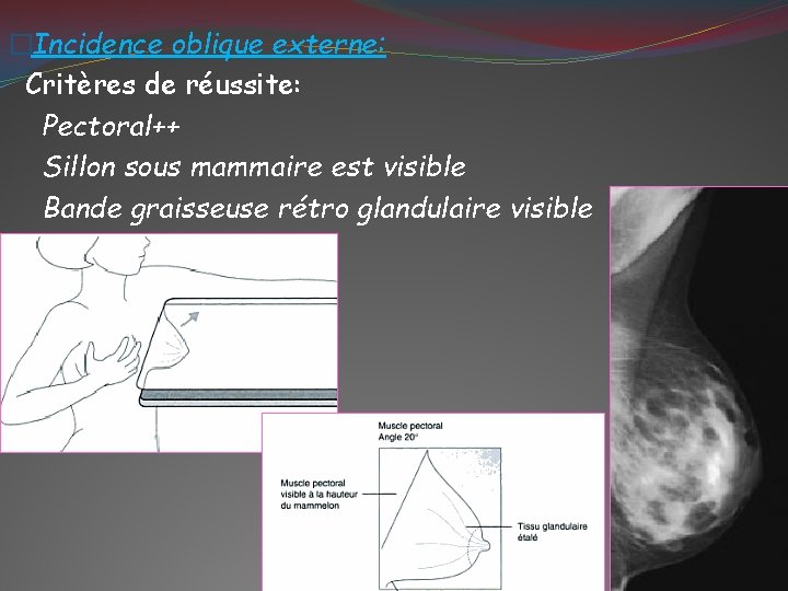 �Incidence oblique externe: Critères de réussite: Pectoral++ Sillon sous mammaire est visible Bande graisseuse