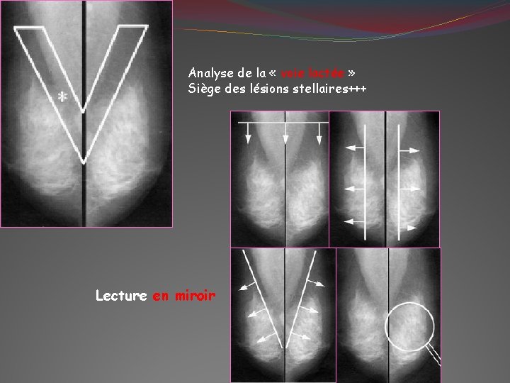 Analyse de la « voie lactée » Siège des lésions stellaires+++ Lecture en miroir
