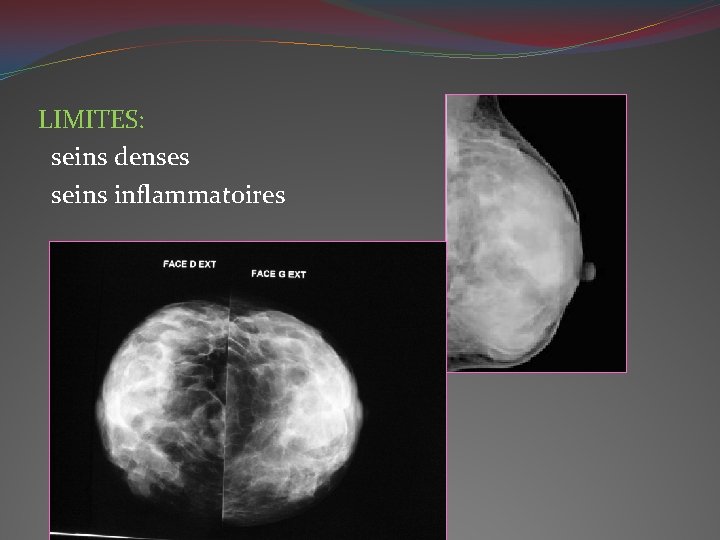 LIMITES: seins denses seins inflammatoires 
