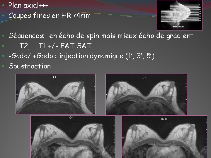  • Plan axial+++ • Coupes fines en HR <4 mm • Séquences: en