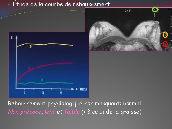  • Étude de la courbe de rehaussement Rehaussement physiologique non masquant: normal Non