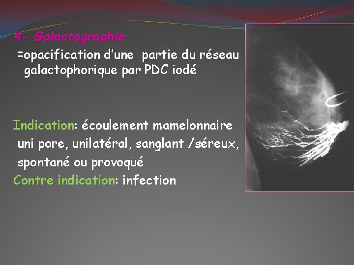 4 - Galactographie =opacification d’une partie du réseau galactophorique par PDC iodé Indication: écoulement