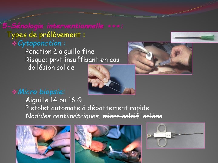 5 -Sénologie interventionnelle +++: Types de prélèvement : v Cytoponction : Ponction à aiguille