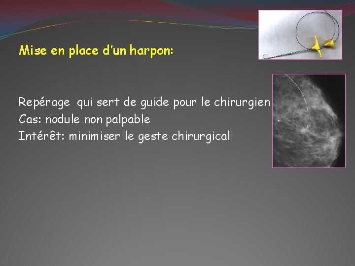 Mise en place d’un harpon: Repérage qui sert de guide pour le chirurgien Cas: