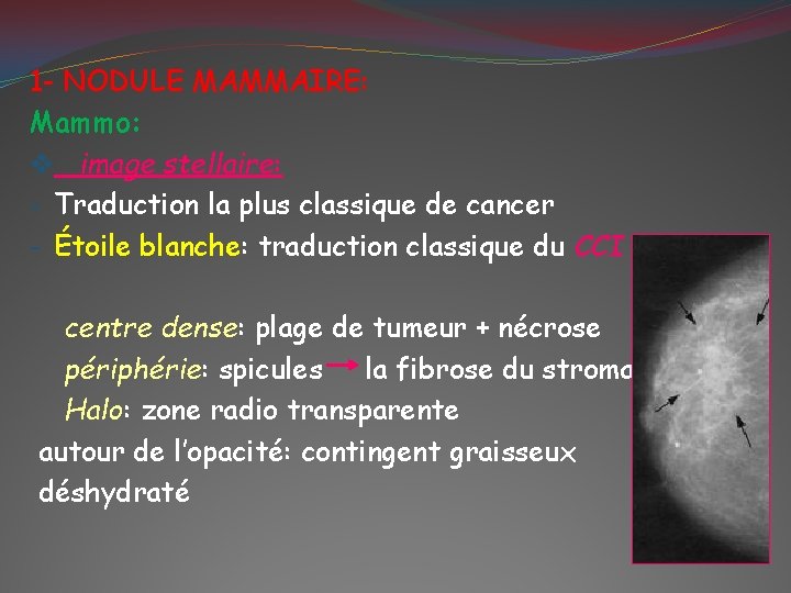 1 - NODULE MAMMAIRE: Mammo: v image stellaire: - Traduction la plus classique de