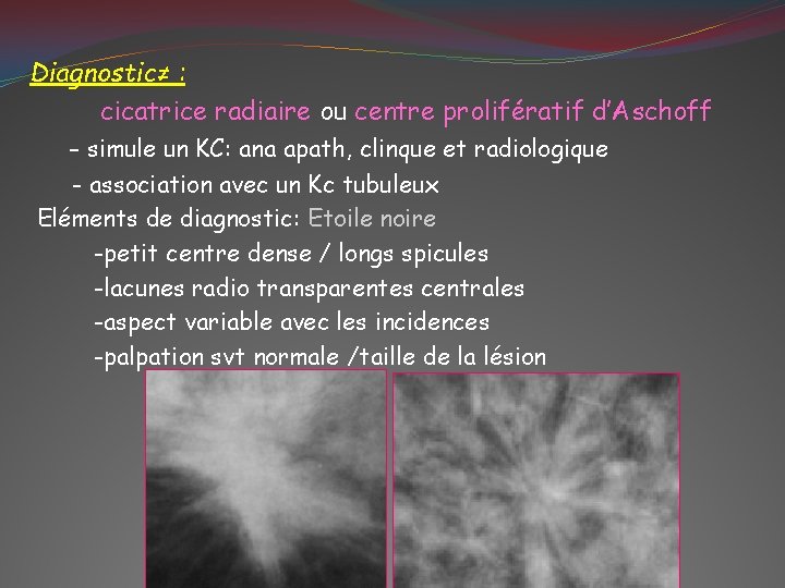 Diagnostic≠ : cicatrice radiaire ou centre prolifératif d’Aschoff - simule un KC: ana apath,