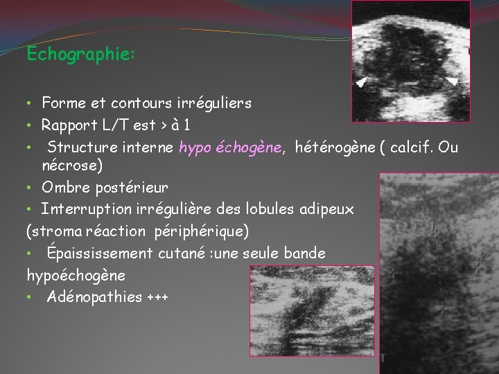 Echographie: • Forme et contours irréguliers • Rapport L/T est > à 1 •