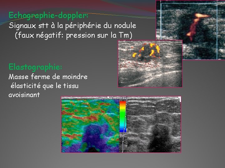 Echographie-doppler: Signaux stt à la périphérie du nodule (faux négatif: pression sur la Tm)