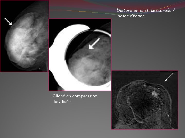 Distorsion architecturale / seins denses Cliché en compression localisée 