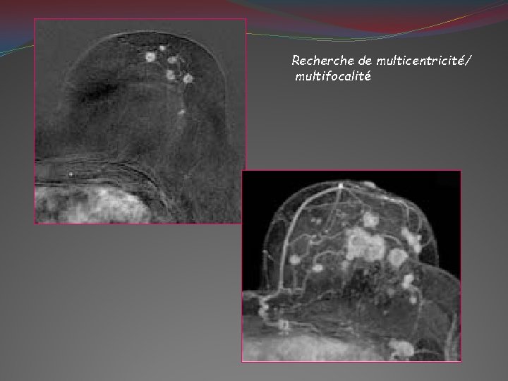 Recherche de multicentricité/ multifocalité 