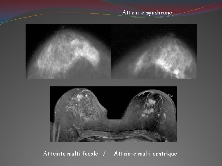 Atteinte synchrone Atteinte multi focale / Atteinte multi centrique 
