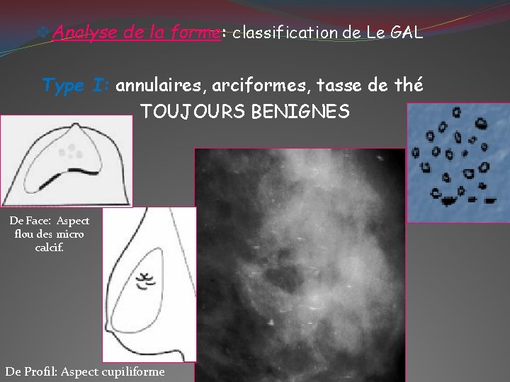 v. Analyse de la forme: classification de Le GAL Type I: annulaires, arciformes, tasse