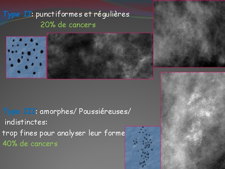 Type II: punctiformes et régulières 20% de cancers Type III: amorphes/ Poussiéreuses/ indistinctes: trop