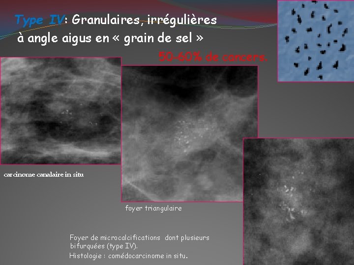 Type IV: Granulaires, irrégulières à angle aigus en « grain de sel » 50