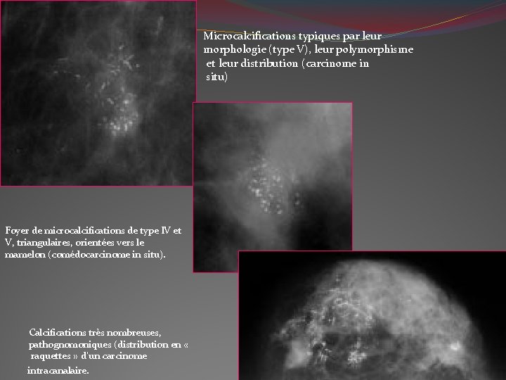Microcalcifications typiques par leur morphologie (type V), leur polymorphisme et leur distribution (carcinome in
