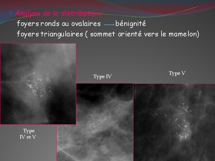 v Analyse de la distribution: foyers ronds ou ovalaires bénignité foyers triangulaires ( sommet
