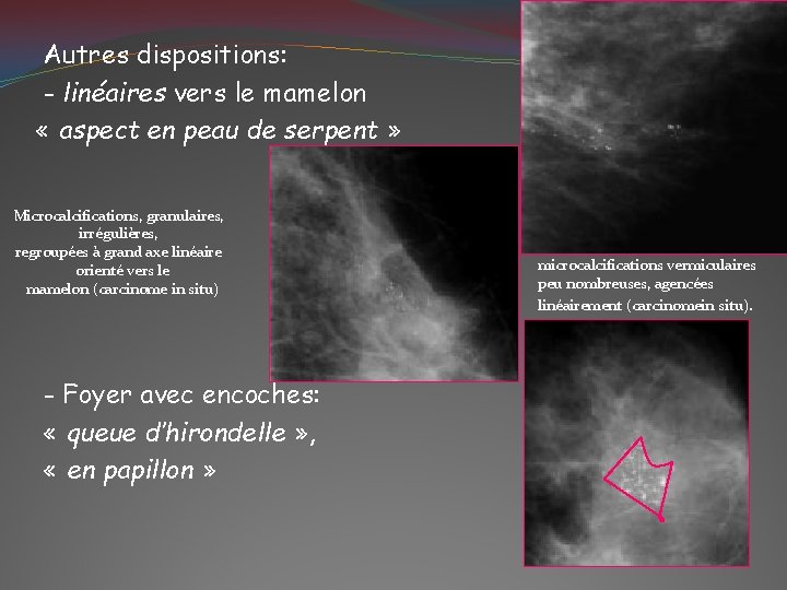Autres dispositions: - linéaires vers le mamelon « aspect en peau de serpent »