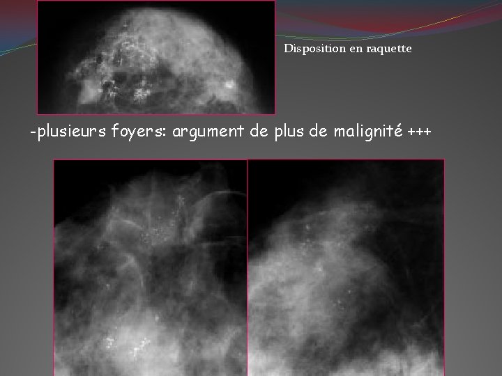Disposition en raquette -plusieurs foyers: argument de plus de malignité +++ 
