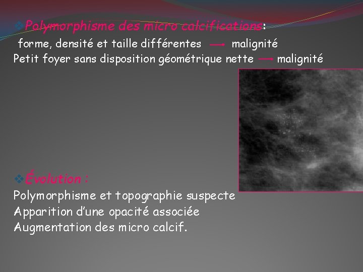 v. Polymorphisme des micro calcifications: forme, densité et taille différentes malignité Petit foyer sans