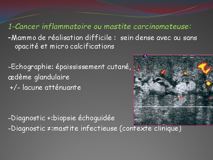 1 -Cancer inflammatoire ou mastite carcinomateuse: -Mammo de réalisation difficile : sein dense avec