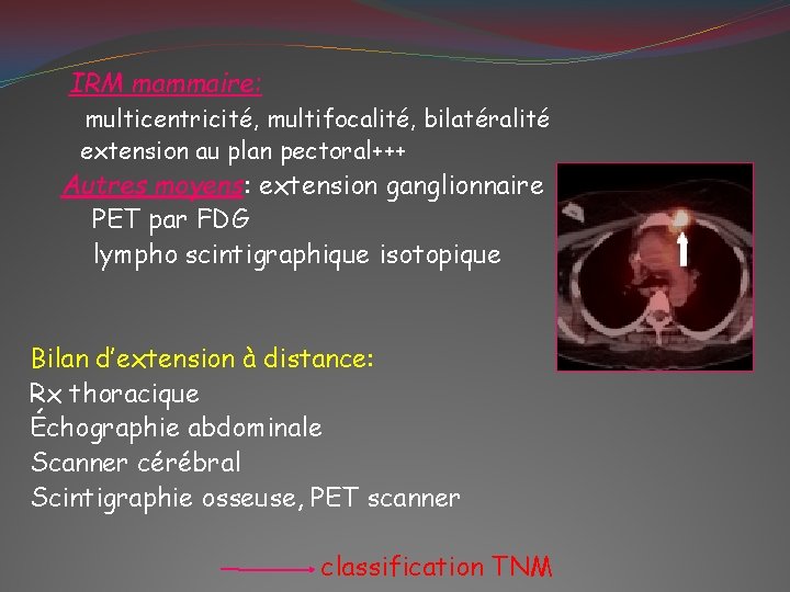 IRM mammaire: multicentricité, multifocalité, bilatéralité extension au plan pectoral+++ Autres moyens: extension ganglionnaire PET