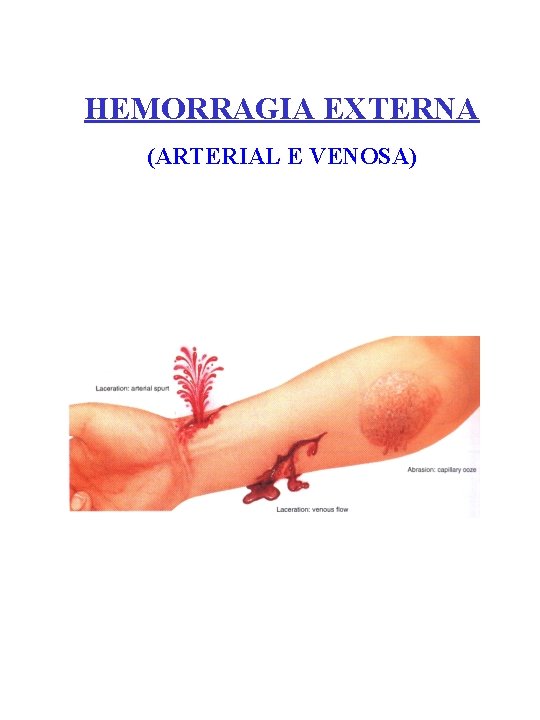 HEMORRAGIA EXTERNA (ARTERIAL E VENOSA) 