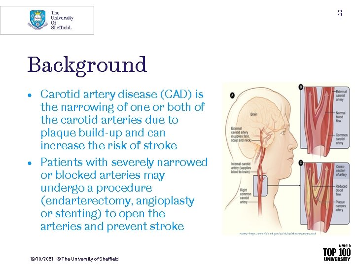 3 Background • Carotid artery disease (CAD) is the narrowing of one or both