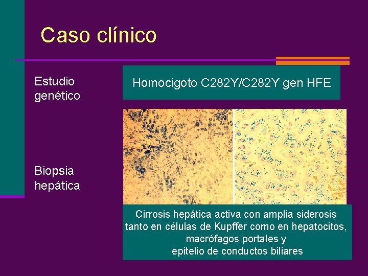 Caso clínico Estudio genético Homocigoto C 282 Y/C 282 Y gen HFE Biopsia hepática