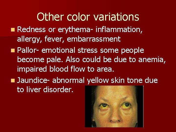 Other color variations n Redness or erythema- inflammation, allergy, fever, embarrassment n Pallor- emotional