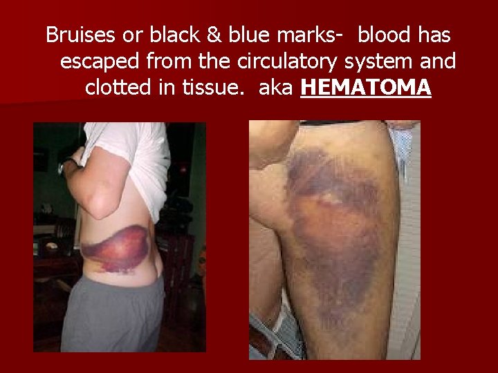 Bruises or black & blue marks- blood has escaped from the circulatory system and