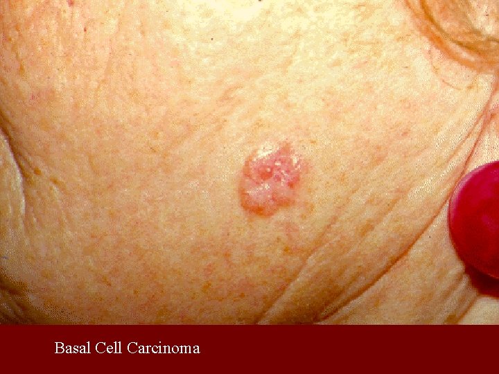 Basal Cell Carcinoma 