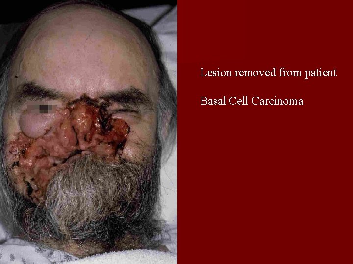 Lesion removed from patient Basal Cell Carcinoma 