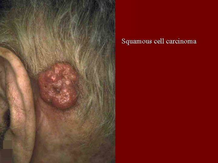 Squamous cell carcinoma 