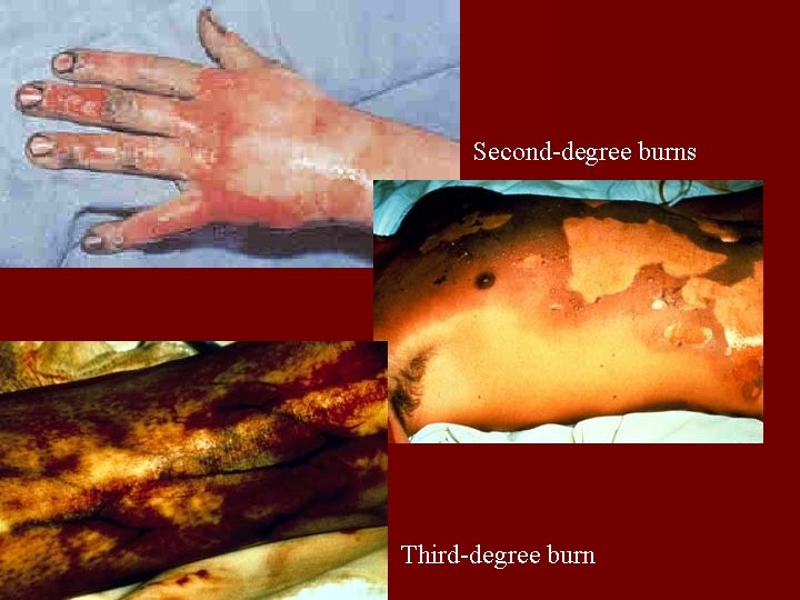 Second-degree burns Third-degree burn 