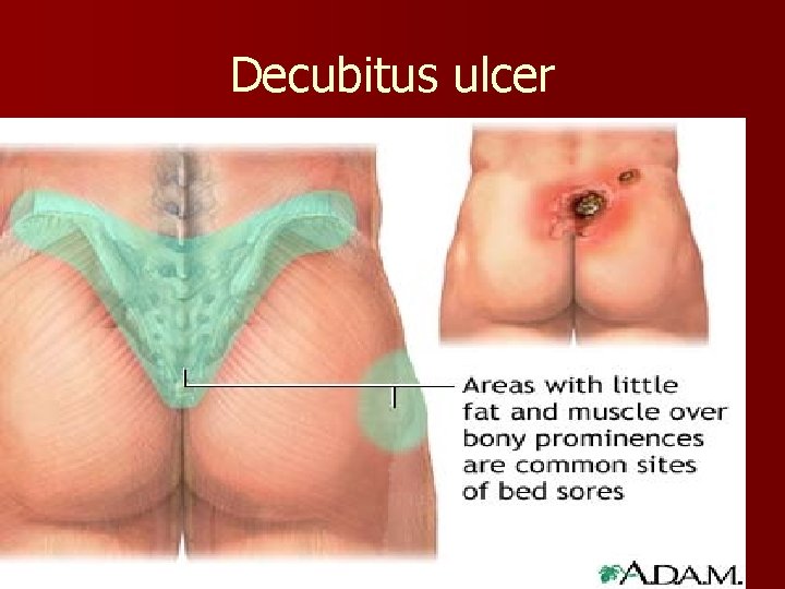 Decubitus ulcer 