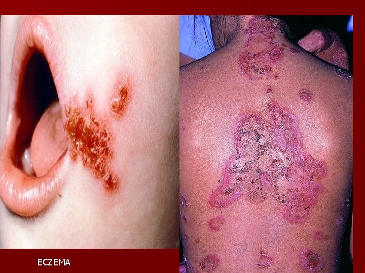 ECZEMA 