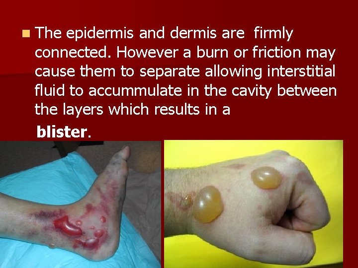 n The epidermis and dermis are firmly connected. However a burn or friction may