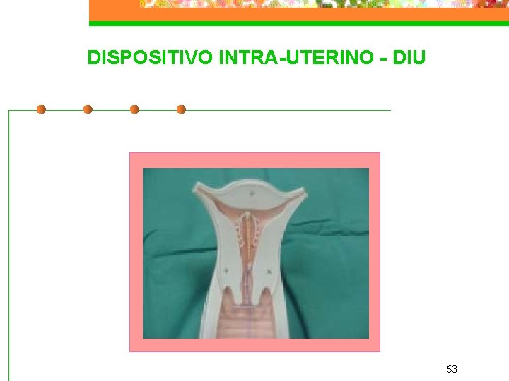 DISPOSITIVO INTRA-UTERINO - DIU 63 