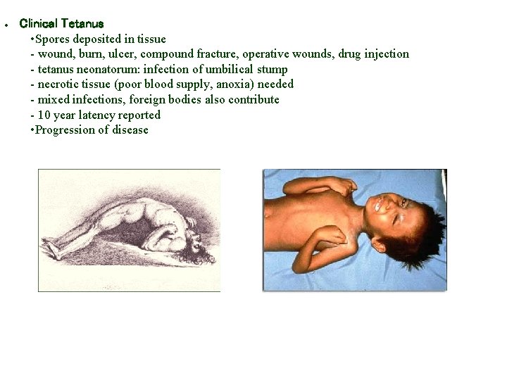 · Clinical Tetanus • Spores deposited in tissue - wound, burn, ulcer, compound fracture,