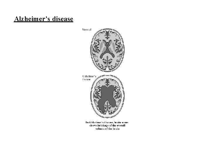 Alzheimer’s disease 