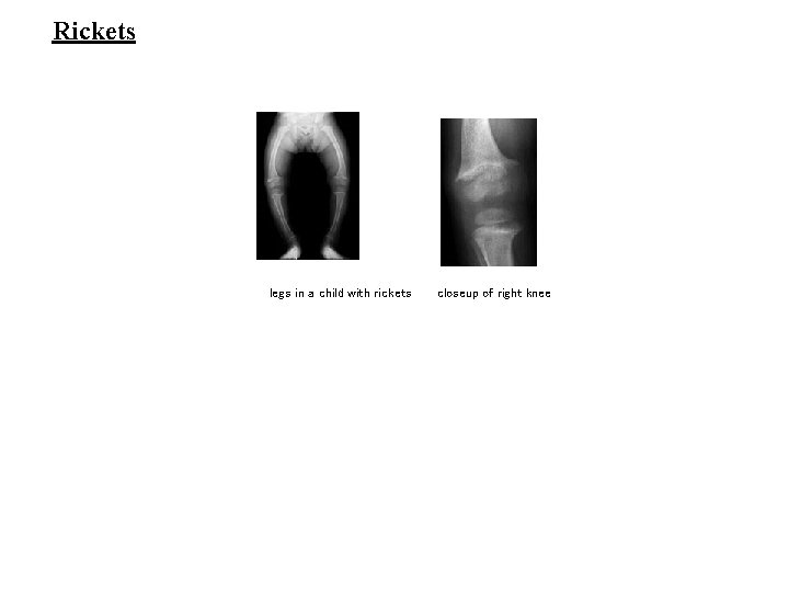 Rickets legs in a child with rickets closeup of right knee 