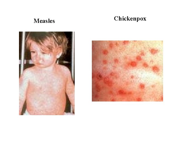 Measles Chickenpox 